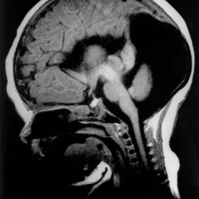 On sagittal SE T1-weighted MR image of the brain