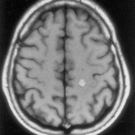 Axial SE T1-weighted MR image of the brain