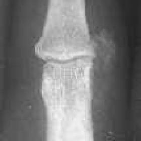 Conventional radiograph of right index finger