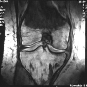 Knee MRI GE T1-weighted coronal image