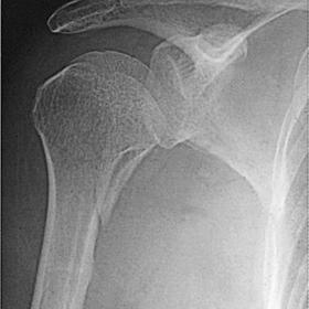Conventional radiographs of the right shoulder