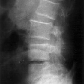 Lateral plain radiography of the lumbar spine