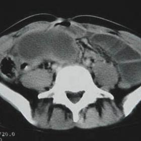 Small bowel necrosis