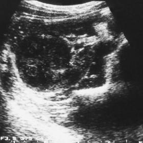 Ultrasonography of the right kidney
