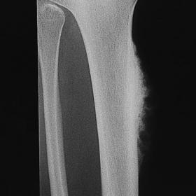 Radiography of the right knee