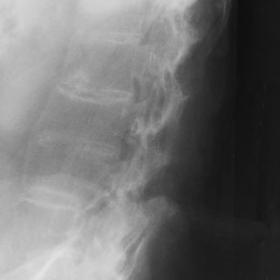 Conventional radiograph of the thoraco-lumbar spine