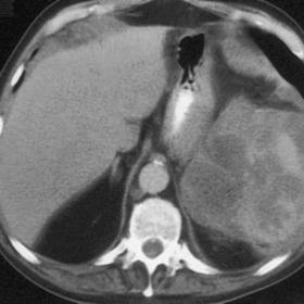 Enhanced CT scan of upper abdomen