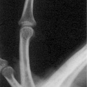 Lateral radiograph of the fourth digit of the left hand
