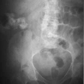 Plain conventional radiography of the abdomen in the supine position