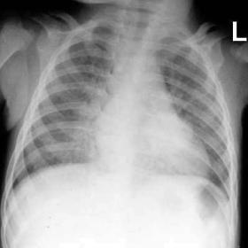 AP chest radiograph