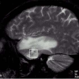 Incidentally detected temporal lobe lesion five years after radiotherapy for parotid mucoepidermoid carcinoma