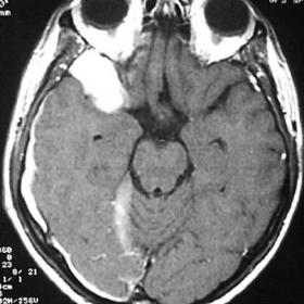 MR imaging, performed immediately after headache.