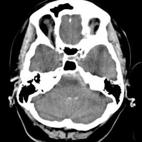 Unenhanced cranial CT scan