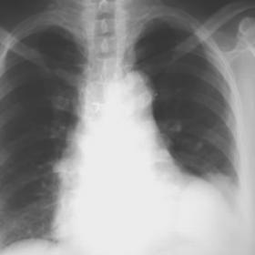 Plain chest-x ray
