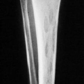 Plain radiography of the right lower leg