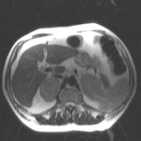 MR imaging of the adrenal glands