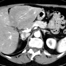 CT imaging and MR imaging of the upper abdomen