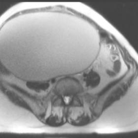 Axial HASTE T2-weighted image