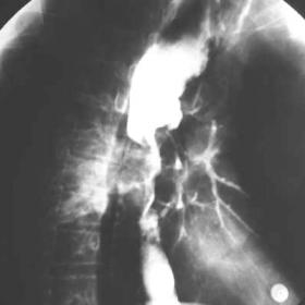 X-Ray: oesophagography