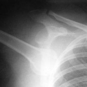X-Ray of shoulder
