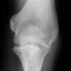 Radiograph of the left elbow