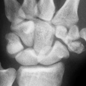 Severely comminuted fracture of the trapezium