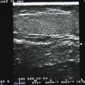 Ultrasound of the knee