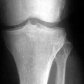 AP radiography of the left knee