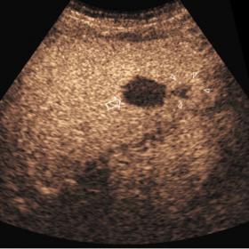 A transverse US scan of the left lobe of the liver obtained after the administration of an echo-amplifier medium