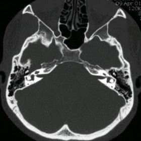 CT scan imaging