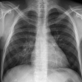 A posteroanterior chest X-ray