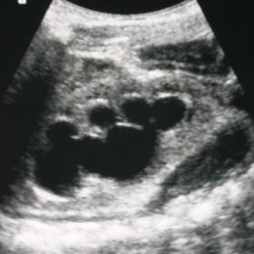 An ultrasound image of the kidney