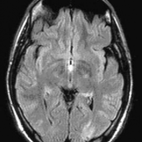 MRI of the brain - FLAIR axial image