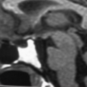 The SE T1-weighted sagittal image showing a shrunken sella turcica and a  hypoplastic anterior pituitary lobe. The pituitary stalk is interrupted and characterized by a hyperintense spot in its distal part.