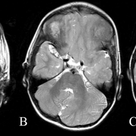 Fig. 1: MR SE T2 weighted axial images showing abnormalities in infratentirial compartment, mainly in left cerebellum.