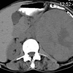 Fig. 1: Axial non enhanced CT scan image of the abdomen showing a large exophytic mass lesion, originating from the upper and middle pole of the left kidney with central hypodense scar.