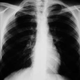 PA chest radiograph
