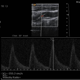 Pulsed Doppler Ultrasound