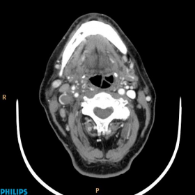 CT scan showing infiltrating mass arising from right lobe of thyroid.