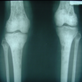 Anteroposterior radiographic of knees
