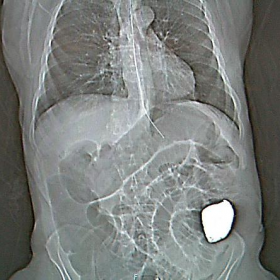 Figure 1: CT Scanogram showing a barolith causing distal colonic obstruction.