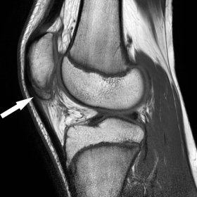 Sagittal T1 weighted Image of Knee
