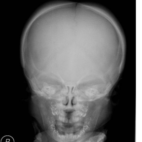 Skull X-Ray ap view