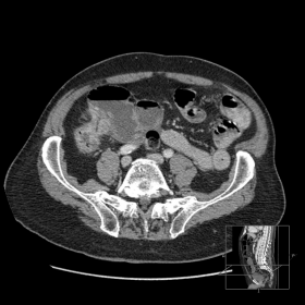 Multi–Detector Row CT. Axial and coronal images at ileocecal valve. Exophitic and pseudopolypoid mass.