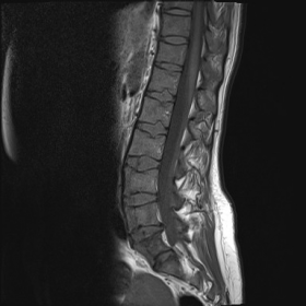 T1 weighted sagittal image of lumbar spine
