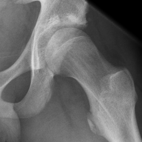 Axial X-ray of the left hip