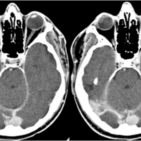 Brain CT after contrast