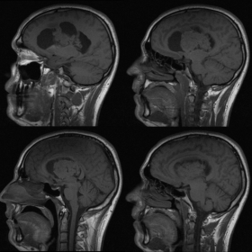 MRI - sagittal T1WI