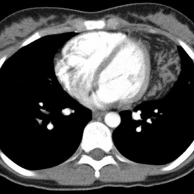 IV-enhanced trans-axial CT of the chest in soft tissue window