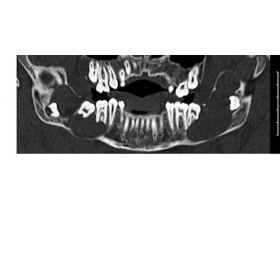 Maxillofacial CT